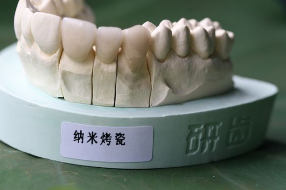 ISO13485 गुड बायोकंपैटिबिलिटी PFM नॉन प्रेशियस डेंटल क्राउन