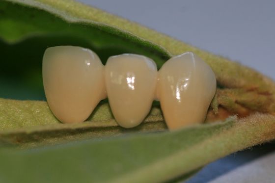 ISO13485 गुड बायोकंपैटिबिलिटी PFM नॉन प्रेशियस डेंटल क्राउन