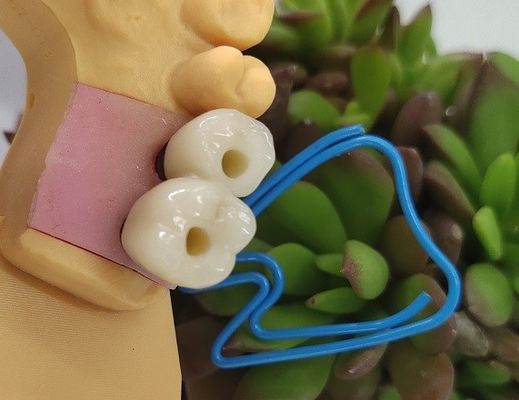 एंडोसियस डेंटल इंप्लांट्स क्राउन