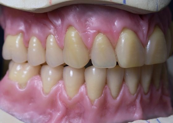 हॉट क्योर फुल आर्क रिमूवेबल एक्रिलिक फुल डेंचर